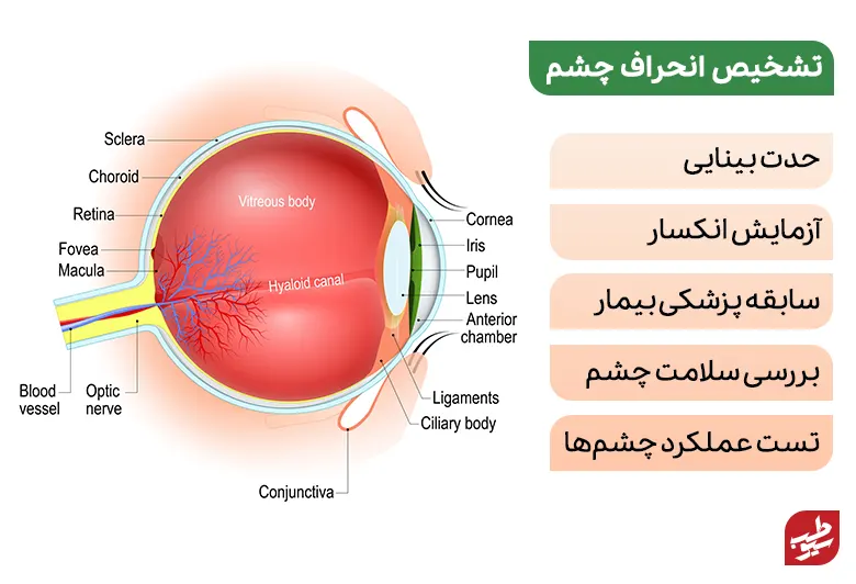 آناتومی چشم انسان و نیاز به درمان انحراف چشم|سیوطب