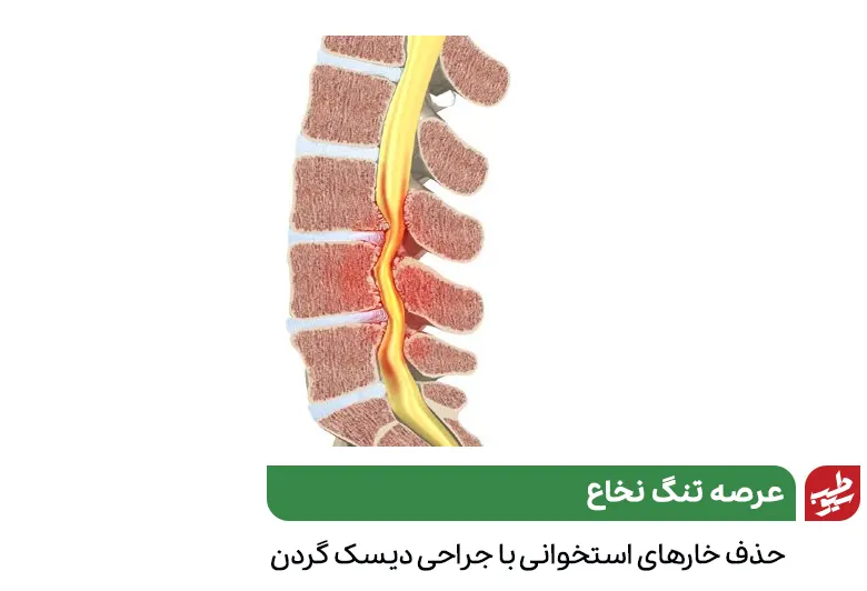 جراحی دیسک گردن برای از بین بردن خارهای استخوانی داخل کانال نخایی که موجب تنگی کانال شده است|سیوطب