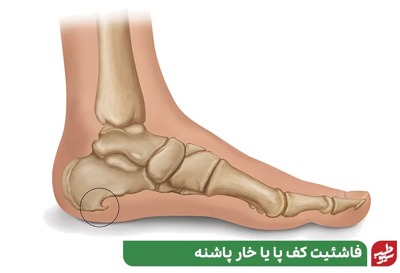 شخصی که به فاشئیت کف پا یا خار پاشنه مبتلا است و به تشخیص علت درد کف پا مبتلاست|سیوطب 