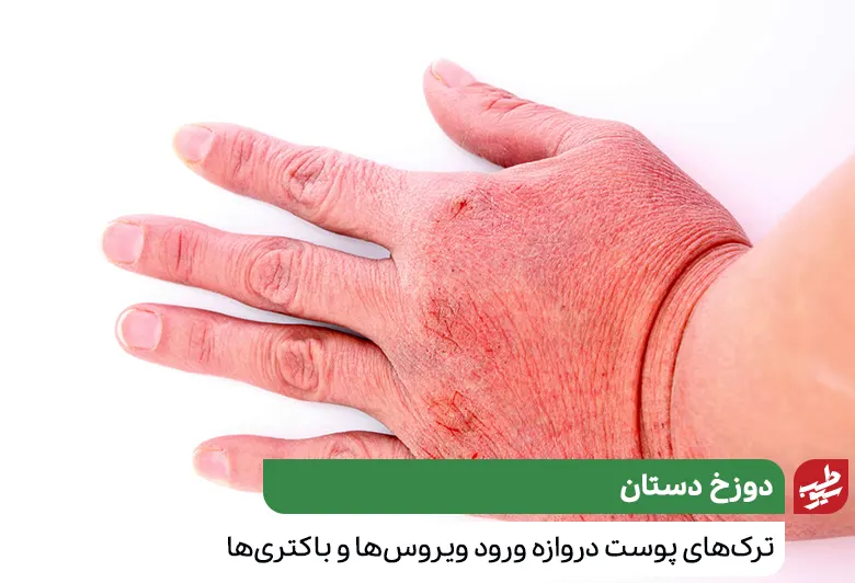درمان خشکی پوست و دستی که دچار ترک‌های خونی شده به خاطر خشکی زیاد|سیوطب