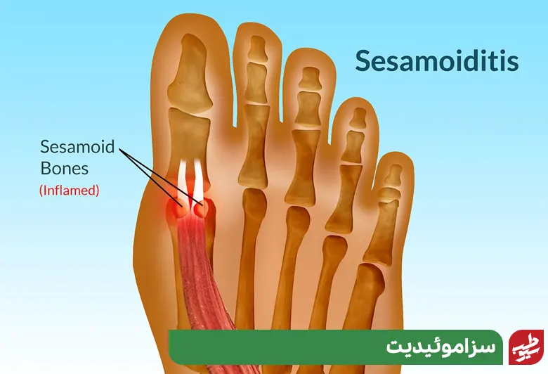 بیمار مبتلا به سزاموئیدیت که در جستجوی یافتن علت درد کف پا است|سیوطب