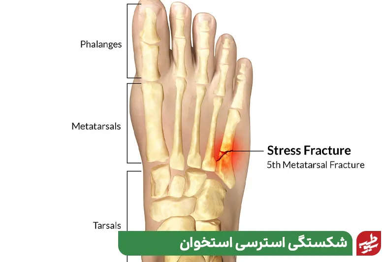بیماری که دچار شکستگی استرسی استخوان  شده به دنبال علت درد کف پا است|سیوطب