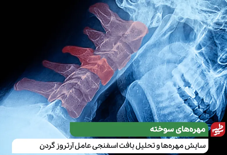 انواع گردن درد ناشی از دیسک و مهره‌هایی ساییده شده که ضخامت مهره‌ها و دیسک‌ها کم شده|سیوطب