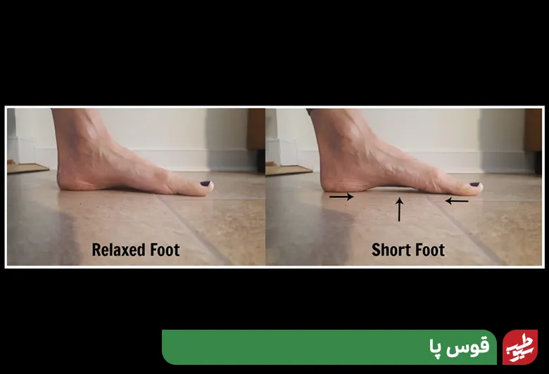 قوس پا ورزشی برای کف پای صاف|سیوطب