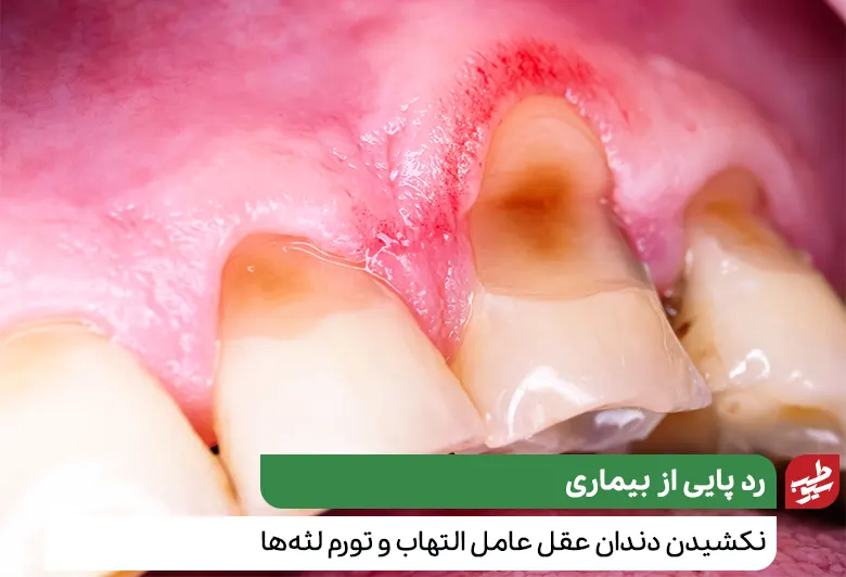 التهاب و قرمزی لثه‌ها به خاطر عدم کشیدن دندان عقل|سیوطب