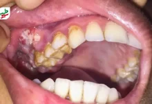 درمان خانگی زخم دهان با شناسایی زخم در سقف دهان|سیوطب