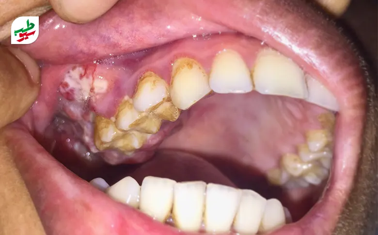 درمان خانگی زخم دهان با شناسایی زخم در سقف دهان|سیوطب