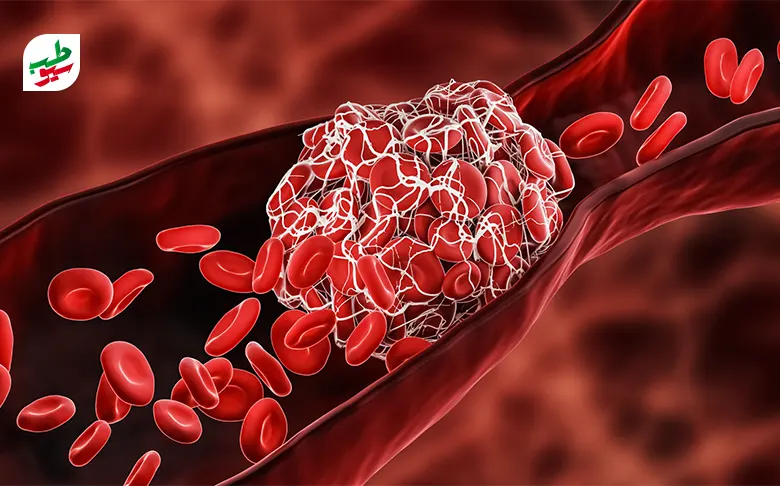 تجمعی از گلبول‌های قرمز در یک نقطه خاص منجر به لخته خون در بدن خواهد شد|سیوطب