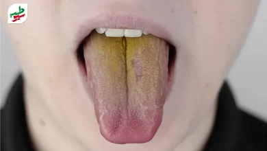 علت زرد شدن زبان متنوع است و می‌تواند عامل بود بد دهان شود|سیوطب