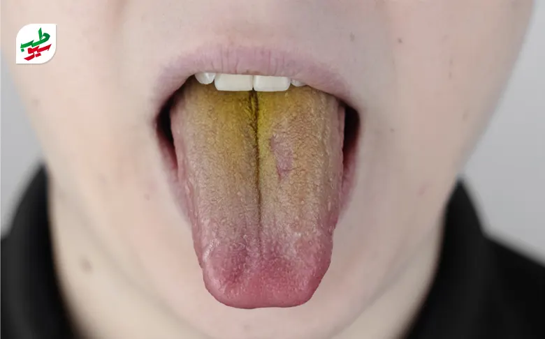 علت زرد شدن زبان متنوع است و می‌تواند عامل بود بد دهان شود|سیوطب
