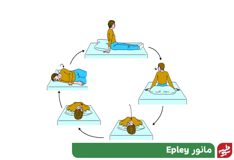 درمان سرگیجه با تمرین مانور Epley|سیوطب