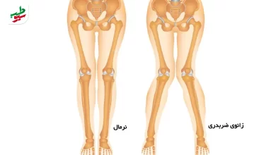 وکتور آناتومی پایی که به ورزش برای پای ضربدری نیاز دارد|سیوطب