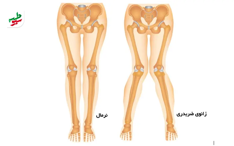 وکتور آناتومی پایی که به ورزش برای پای ضربدری نیاز دارد|سیوطب