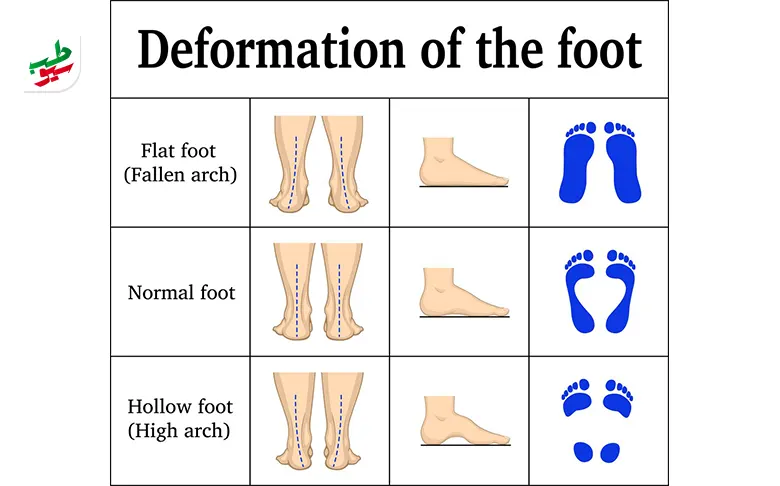 ورزش برای کف پای صاف می‌تواند عوارض را بهبود دهد|سیوطب