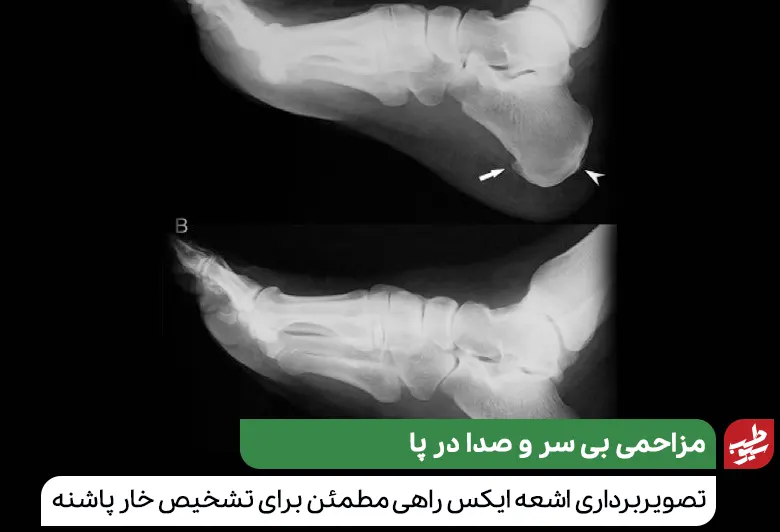 عکس رادیوگرافی که خار پاشنه پا را نشان می‌دهد|سیوطب