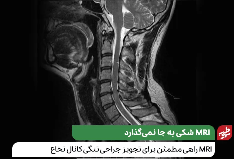 MRI مهره‌های گردن که صحت تجویز عمل جراحی تنگی کانال نخاع گردن را تایید می‌کند|سیوطب