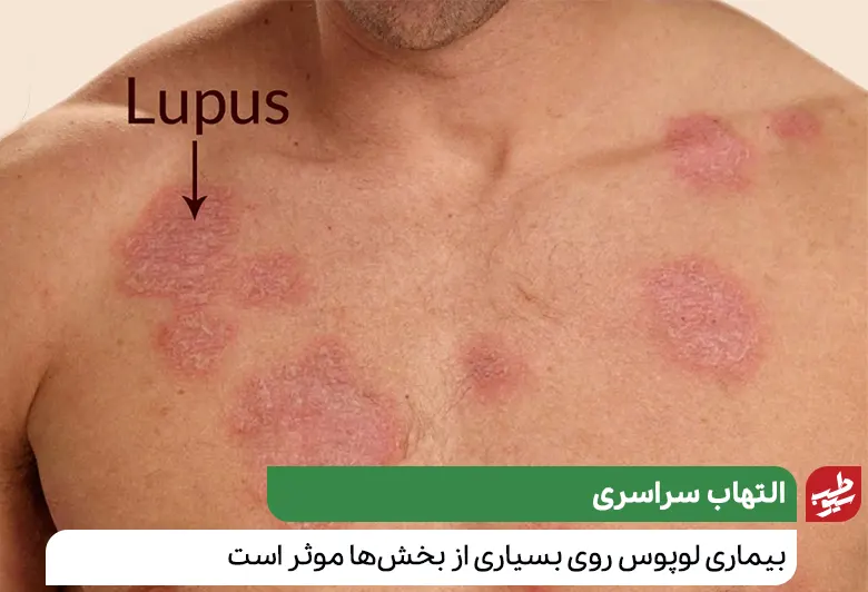 لکه‌های قرمز بیماری لوپوس روی سینه|سیوطب