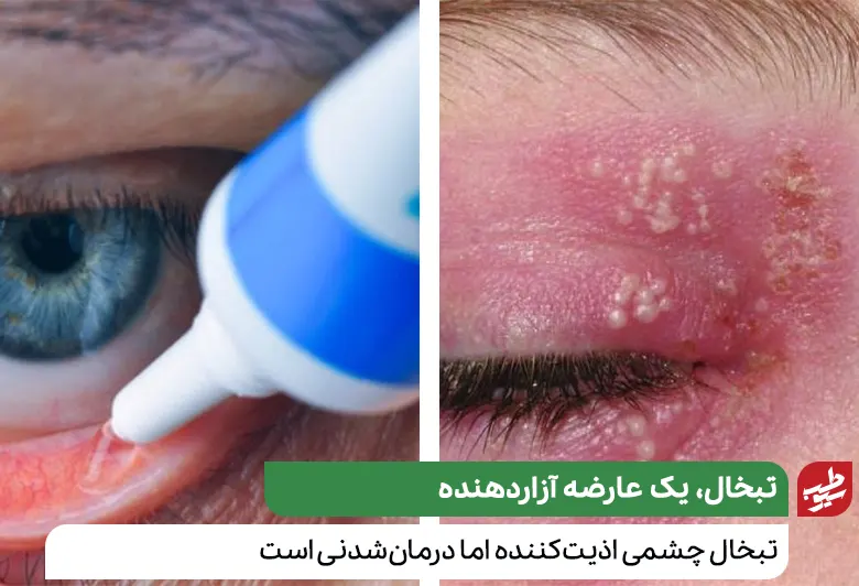 درمان زخم داخل پلک ناشی از تبخال چشمی با مصرف داروهای استروئیدی و ضدویروسی|سیوطب