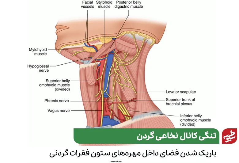 وکتور آناتومی گردن و درمان تنگی کانال نخاعی گردن|سیوطب
