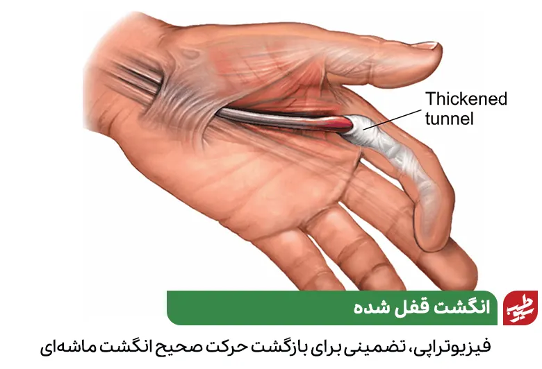 دستی که دچار عارضه انگشت ماشه‌ای شده و نیاز به فیزیوتراپی دست دارد|سیوطب