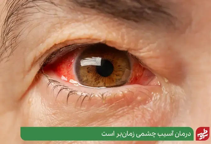 درمان قرمزی چشم به علت آن بستگی دارد|سیوطب