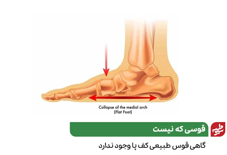 وکتور آناتومی کف پای صاف برای تشخیص صافی کف پا|سیوطب