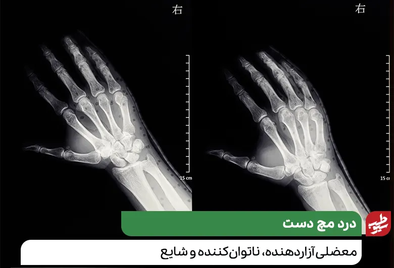 آزمایش سی تی اسکن برای بررسی علت درد مچ دست|سیوطب