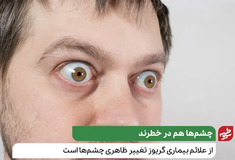 تاثیر بیماری گریوز بر چشم‌ها|سیوطب