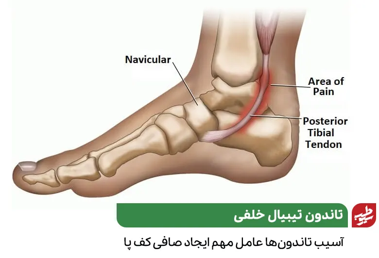 آناتومی تاندونی در پا که موجب صافی کف پا می‌شود|سیوطب
