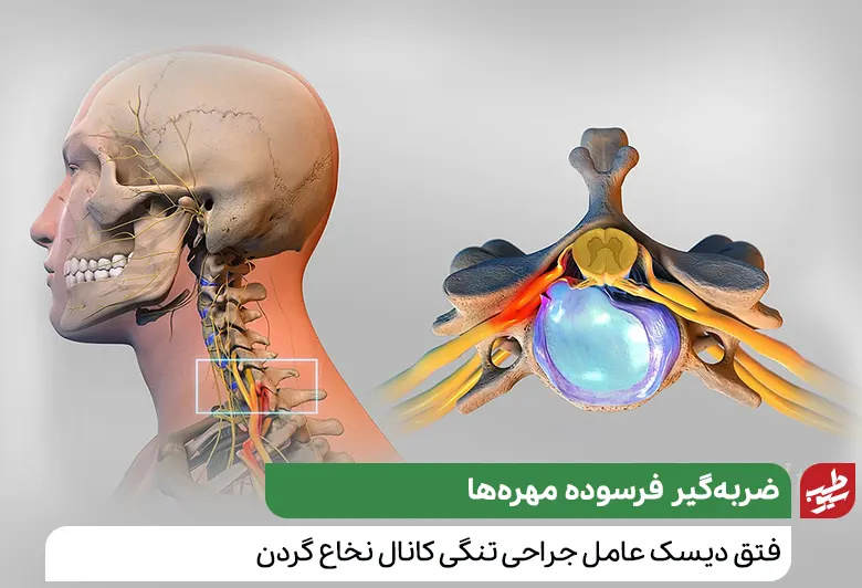 مهره‌‎های گردن که دچار فتق دیسک شده و نیاز به عمل جراحی تنگی کانال نخاع گردن دارد|سیوطب