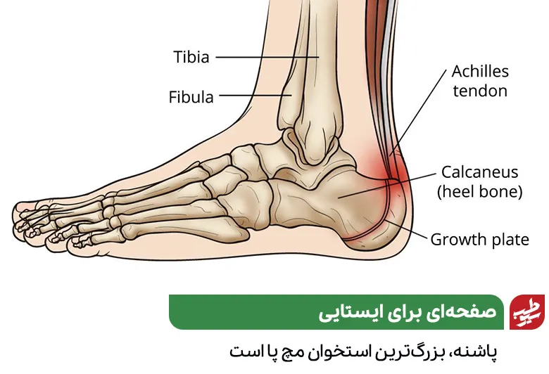 وکتور آناتومی کف پای شخصی که به درد پاشنه پا مبتلا است|سیوطب
