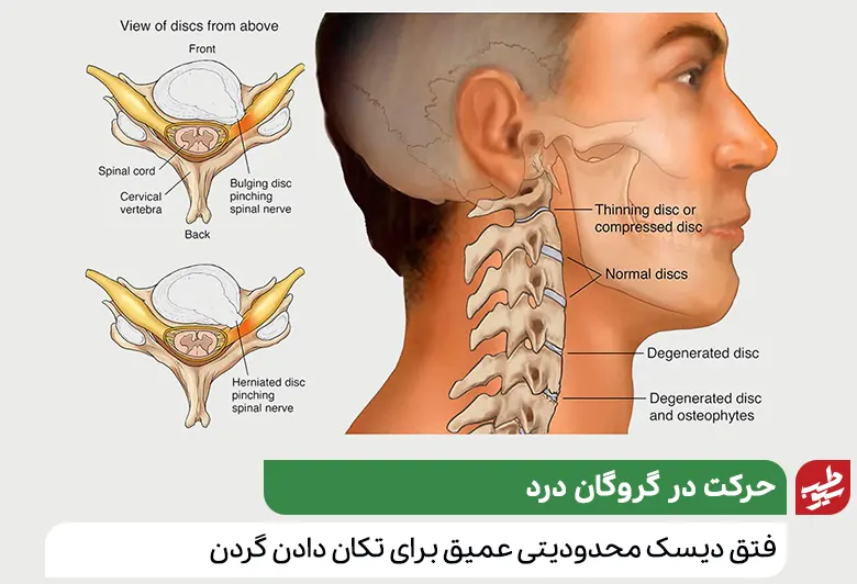 آناتومی گردن که دچار آسیب دیسک شده و نیاز به گردنبند طبی دیسک گردن دارد|سیوطب 