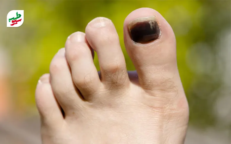 درمان سیاه شدن ناخن پا به علت آن بستگی دارد|سیوطب