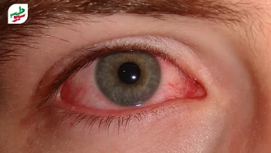 درمان قرمزی چشم با راه‌های مختلفی امکان پذیر است|سیوطب