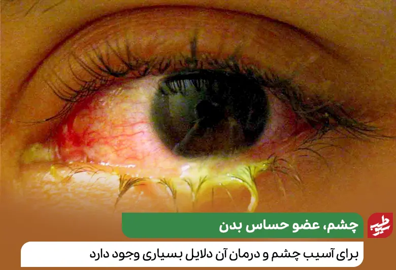 درمان زخم داخل پلک به دلیل عفونت باکتریایی با مصرف انتی‌بیوتیک‌ها صورت می‌گیرد|سیوطب