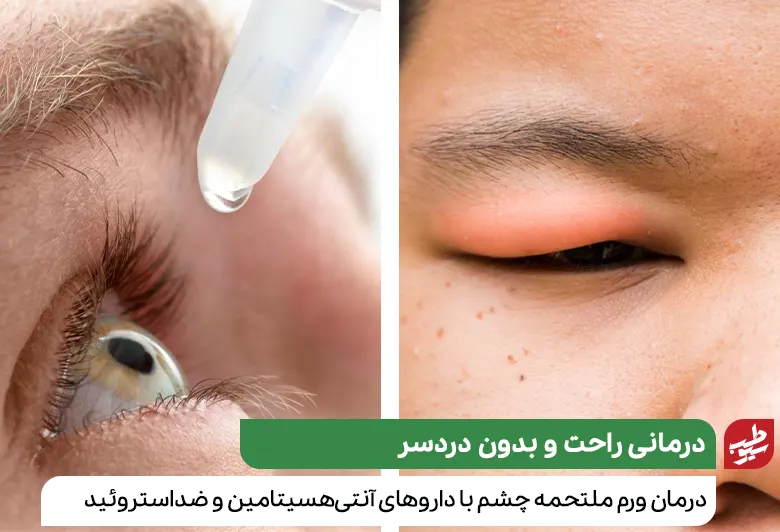 درمان زخم داخل پلک به دلیل ورم ملتحمه با آنتی هسیتامین‌ها ممکن است|سیوطب