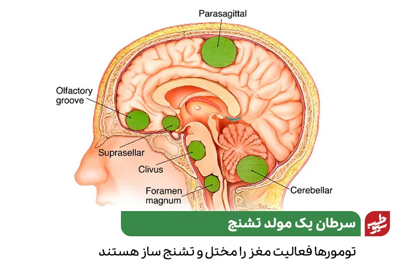 درمان تشنج در مغزی که به تومور سرطانی مبتلا است|سیوطب 