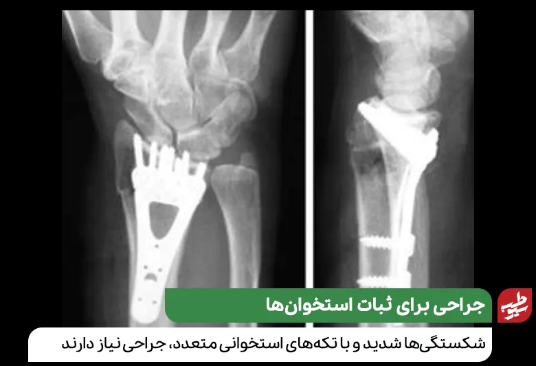 درمان شکستگی استخوان مچ دست با جراحی و قراردادن تجهیزاتی برای ثبات استخوان‌ها|سیوطب