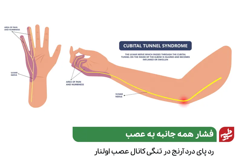 سندروم تونل کوبیتال علت دست درد آرنج به پایین|سیوطب
