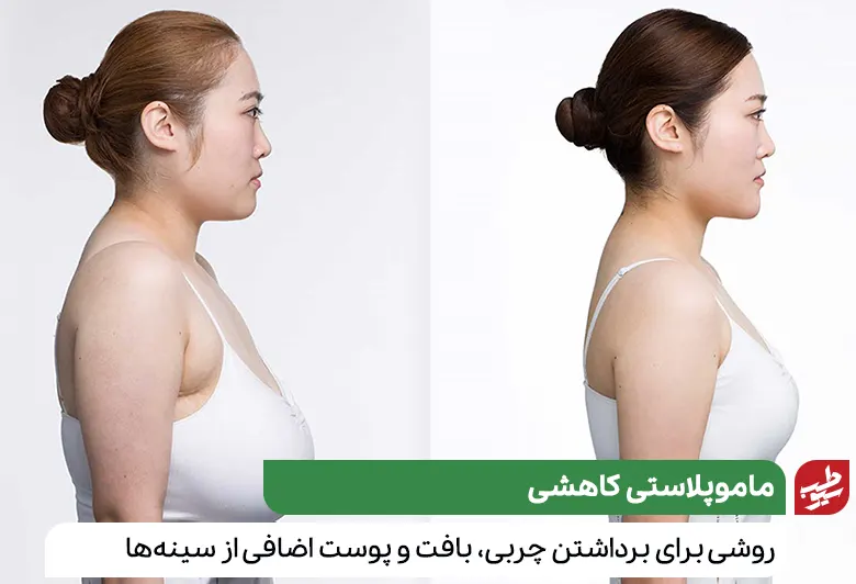 زنی قبل و بعد از جراحی کوچک کردن سینه|سیوطب