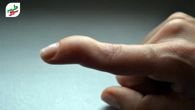 فردی دچار عارضه انگشت چکشی شده اشت|سیوطب