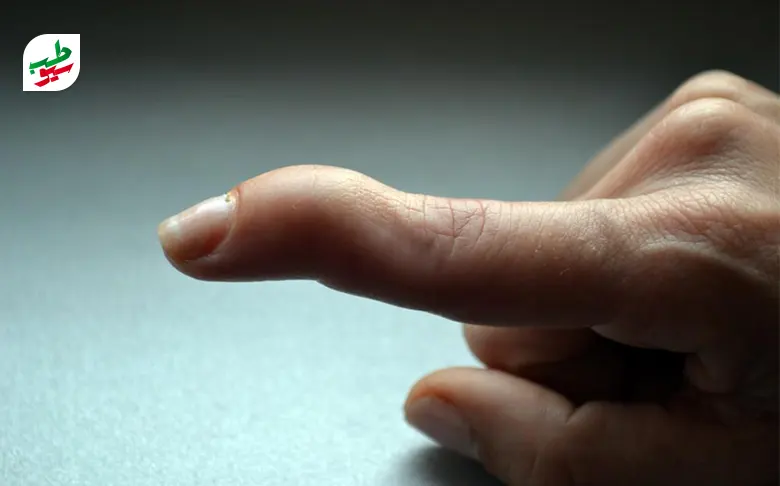 فردی دچار عارضه انگشت چکشی شده اشت|سیوطب