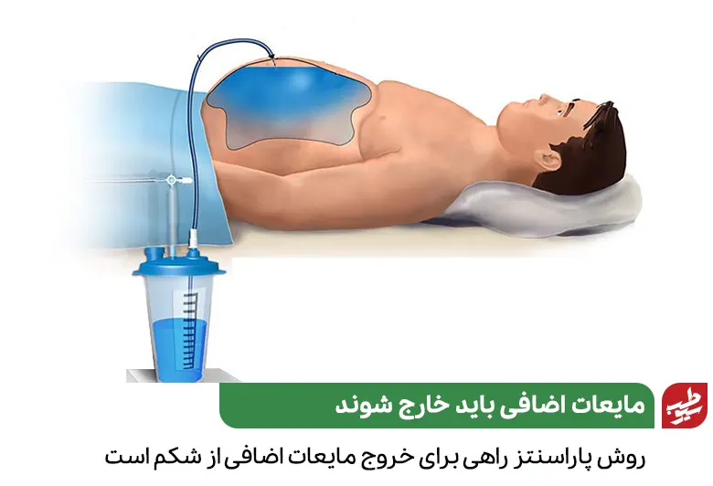 خارج کردن مایعات از شکم راهی برای درمان تورم ناحیه شکم به دلیل جمع شدن مایعات اضافی است|سیوطب