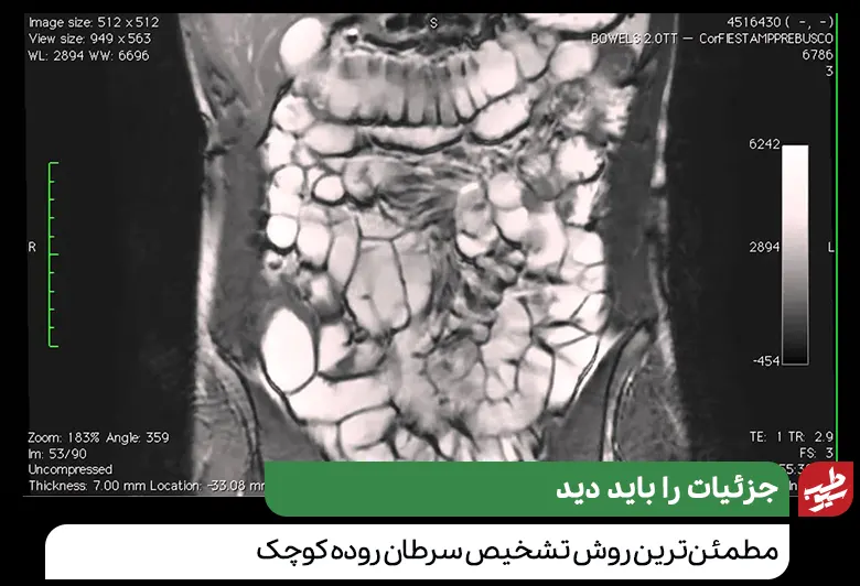 تصویر MRI برای شناسایی سرطان روده کوچک|سیوطب
