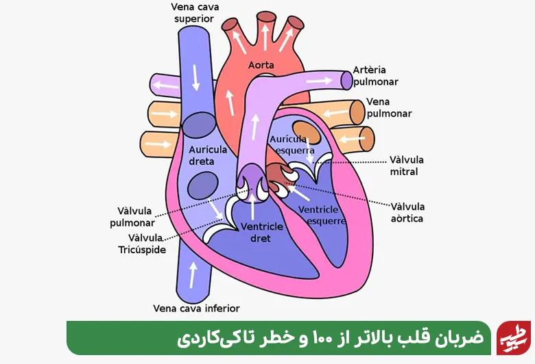 آناتومی قلبی که مبتلا به عارضه تپش قلب شدید شده است|سیوطب