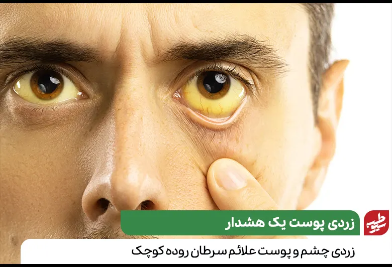 زردی چشم و پوست از علائم سرطان روده کوچک|سیوطب