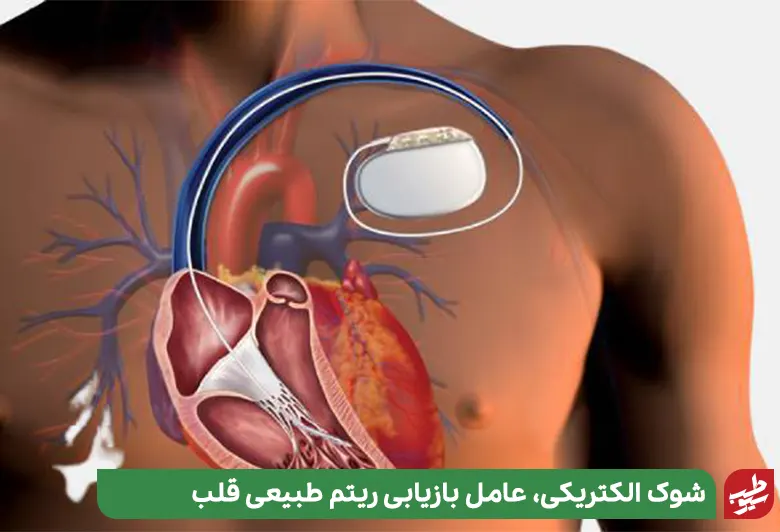 آناتومی قلب که برای کنترل تپش قلب شدید کاشت دفیبریلاتور انجام داده است| سیوطب