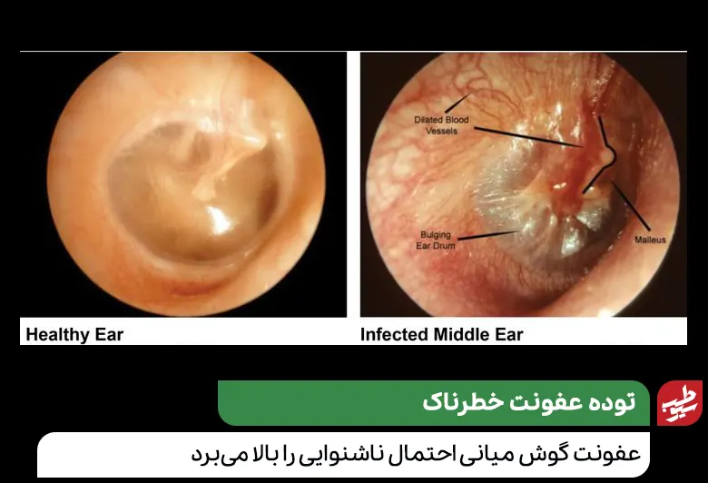 گوش میانی سالم و عفونت کرده و تشخیص لزوم جراحی گوش کودکان|سیوطب
