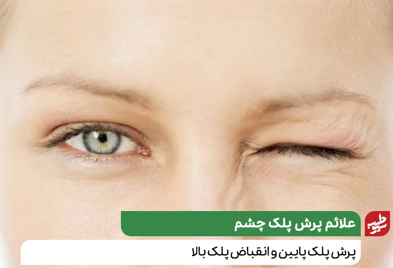 زنی که به درمان پرش پلک چشم نیاز دارد|سیوطب