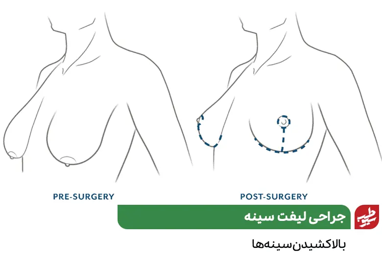 قبل و بعد از جراحی لیفت سینه|سیوطب